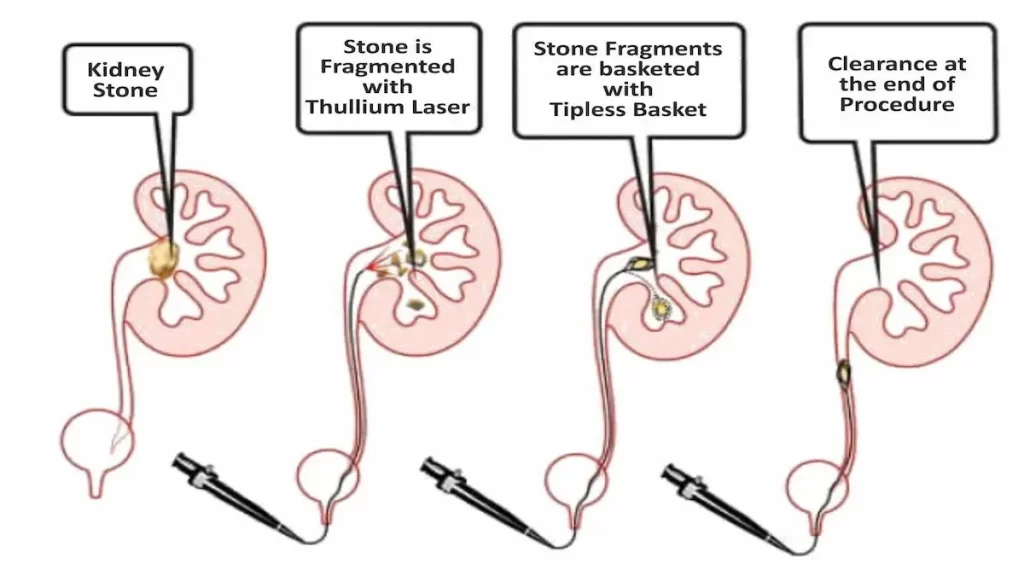 How to prevent Kidney Stones