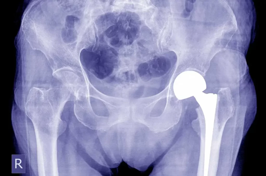 Best Partial Hip Replacement Surgery hospital in Chennai OVERVIEW