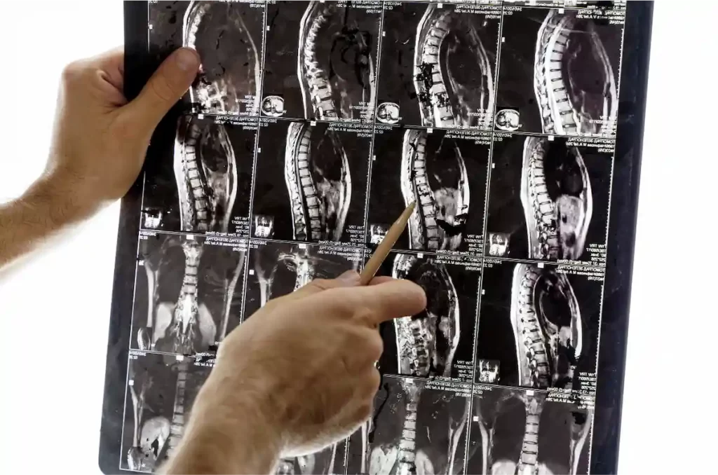 Vertebroplasty and Kyphoplasty Treatment in Chennai - Diagnosis
