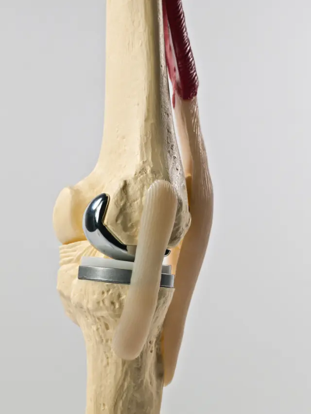 Sams orthopedic i total 2025 knee replacment n chennai