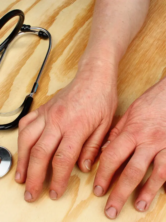 Introduction to Rheumatoid Arthritis