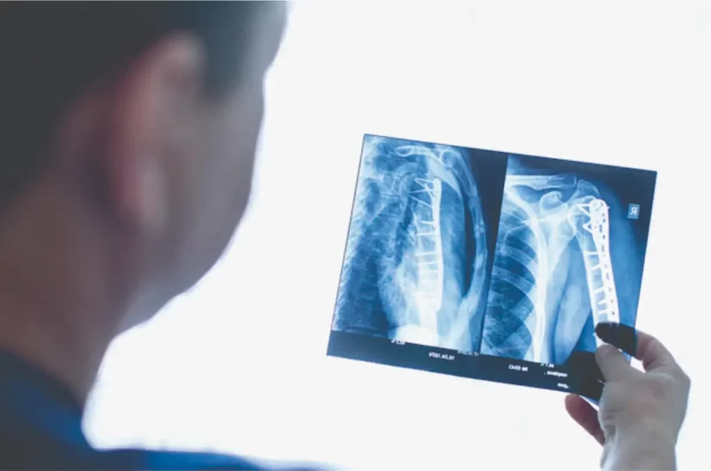 Spine Surgery - Shoulder Dislocation- Diagnosis