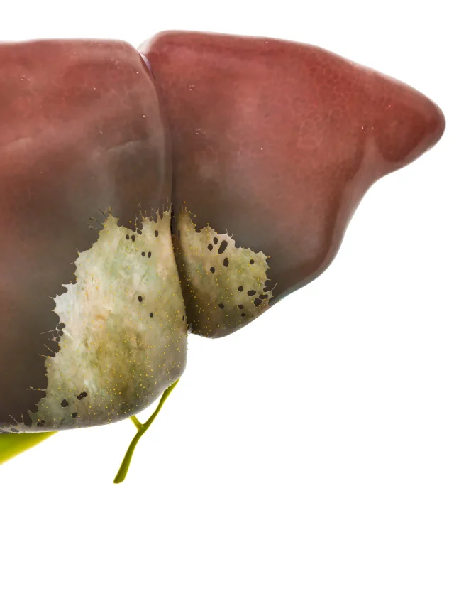 How to Prevent Liver Cirrhosis