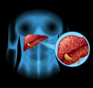 Non-Alcoholic Fatty Liver Disease (NAFLD)