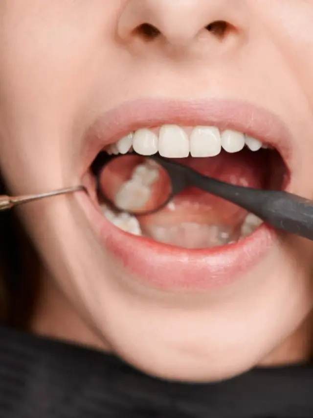 Causes of Teeth Replacement