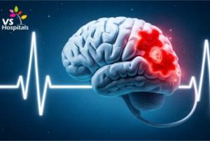 Brain Stroke vs